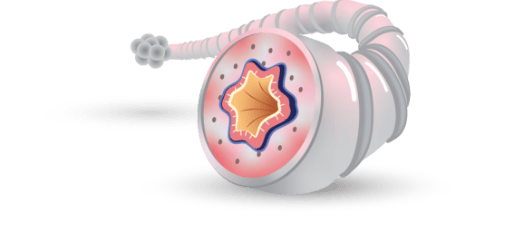 ICS (fluticasone furoate) reduces inflammation ICS (fluticasone furoate) reduces inflammation